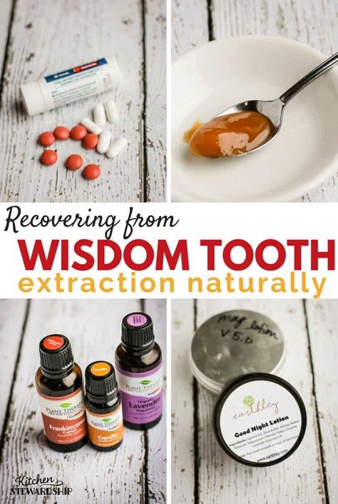 I got 3 wisdom teeth removed without general anesthesia! Here are all my tips for natural pain relief for wisdom teeth removal recovery with no pain killers. #naturalhealth #wisdomteeth #dentist #homeopathy Getting Wisdom Teeth Out, Wisdom Teeth Removal Recovery, Wisdom Teeth Food, Wisdom Teeth Pain Relief, Wisdom Teeth Recovery, Tooth Pain Remedies, Wisdom Teeth Pain, After Wisdom Teeth Removal, General Anesthesia