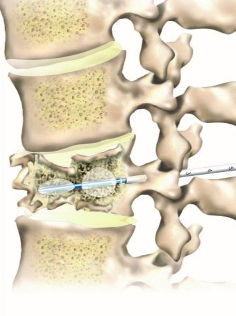 Kyphoplasty is a minimally invasive surgical procedure commonly used for spinal compression fractures as it stabilizes the fracture. If you are experiencing a back fracture, call our specialists at 888-409-8006. #spinedoctor #backpain Bone Healing Foods, Lumbar Pain, Spinal Surgery, Spine Surgery, Sciatic Nerve Pain, Sciatic Nerve, Market Analysis, Bone Density, Body Pain