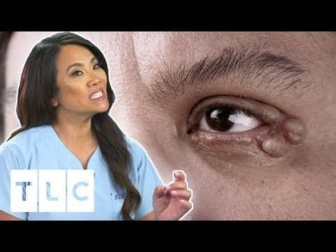 Dr Lee Removes Multiple Cysts From Woman's Eye Lids | Dr. Pimple Popper | CENSORED Dr Pimple Popper Blackhead Youtube, Doctor Pimple Popper Videos, Ear Pimple Poppìng Videos, Eye Pimple, Pimple Poppìng Videos And Cysts, Dr Pimple Popper Youtube, Pimple On Eyelid, Neck Pimples, Lip Pimple