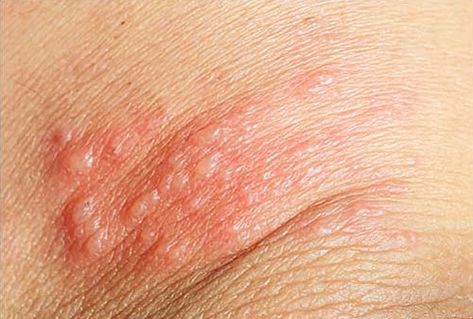 18 Acute Skin Rashes for Nurses to Know (with pictures) | Health And Willness Strep Rash, Ringworms In Humans Pictures, Gluten Rash Pictures, Rash On Stomach, Hives Rash, Skin Rashes Pictures, Inner Thigh Rash, Rash On Back, Leg Rash