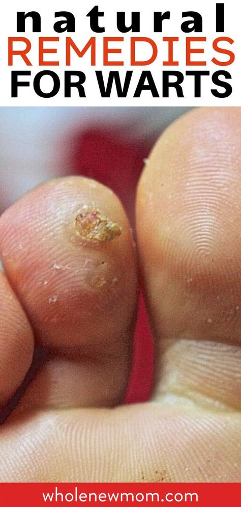 How to get rid of warts at home naturally. Warts on your hands feet and even face can be so difficult to get rid of. However help is at hand with these natural wart remedies that really work. including one that will surprise you! Plantar Wart Remedies, Wart Remedies, Natural Wart Remedies, Diy Hair Serum, Wart On Finger, Gallbladder Health, Home Remedies For Warts, Warts Remedy, All Natural Home