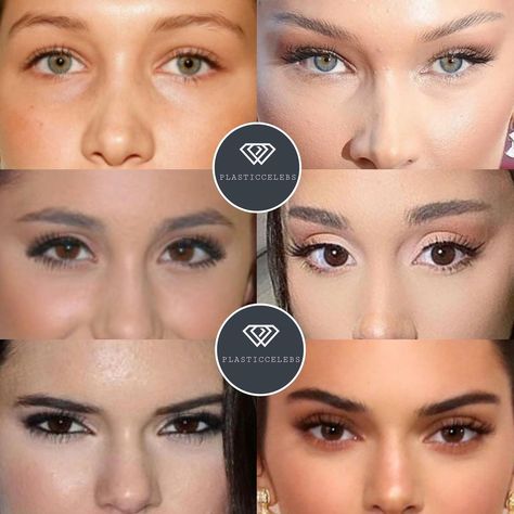 Eyebrow Lift Surgery, Ariana Grande Eyebrows, Bella Hadid Surgery, Rhinoplasty Lip Lift, Ariana Grande Plastic Surgery, Bella Hadid Before Surgeries, Eyebrow Lift, Cosmetic Surgery, Kendall Jenner