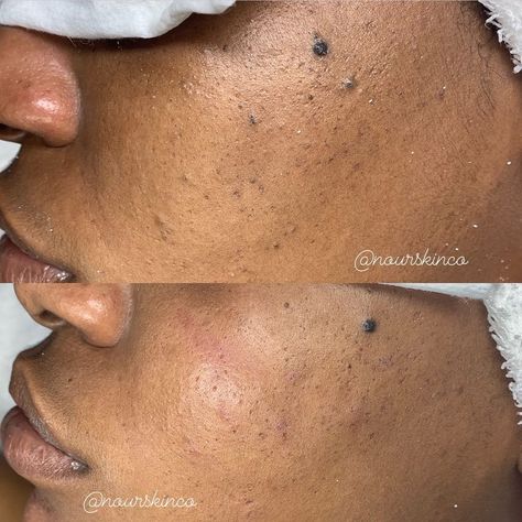 Aisha King•Houston Esthetician on Instagram: “Before and after extractions! Client�’s concern were blackheads causing noticeable texture to her skin. We did the acne targeting facial…” Extractions Facial, Acne Transformation, Facial Before And After, Pimples On Scalp, Pimple Causes, Clean Blackheads, Mole Removal, Skin Tags, Get Rid Of Blackheads