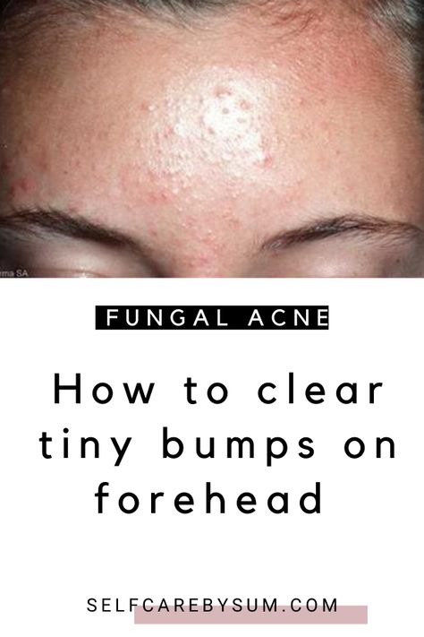 Generated Description with relevant hashtags. Tiny Bumps On Forehead, Get Rid Of Fungal Acne, Forehead Pimples, Bumps On Forehead, Nails Remedies, Forehead Breakout, Nizoral Shampoo, Small Bumps On Face, Forehead Bumps