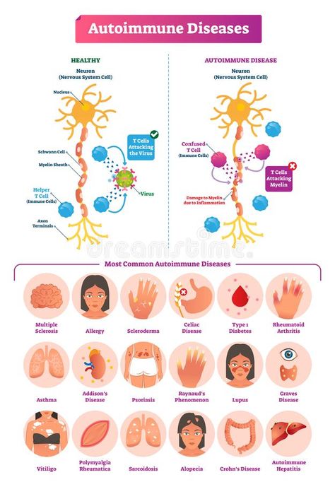 Medical Textbooks, Illustration Infographic, Skin Grafting, Autoimmune Disorder, Medical Knowledge, Anatomy And Physiology, The Human Body, Autoimmune Disease, Medical Conditions