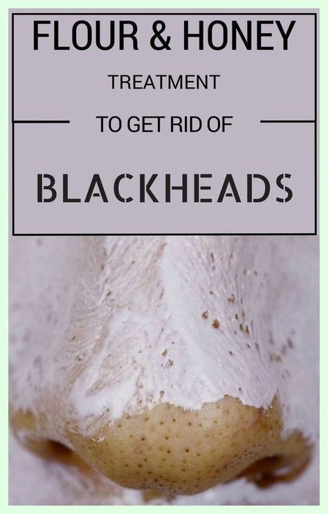 I couldn’t have done it without you. Priceless info Black Heads, Home Beauty Tips, Health Tips For Women, Get Rid Of Blackheads, Diy Health, Natural Herbs, Blackhead Remover, The Favorite, Health Advice