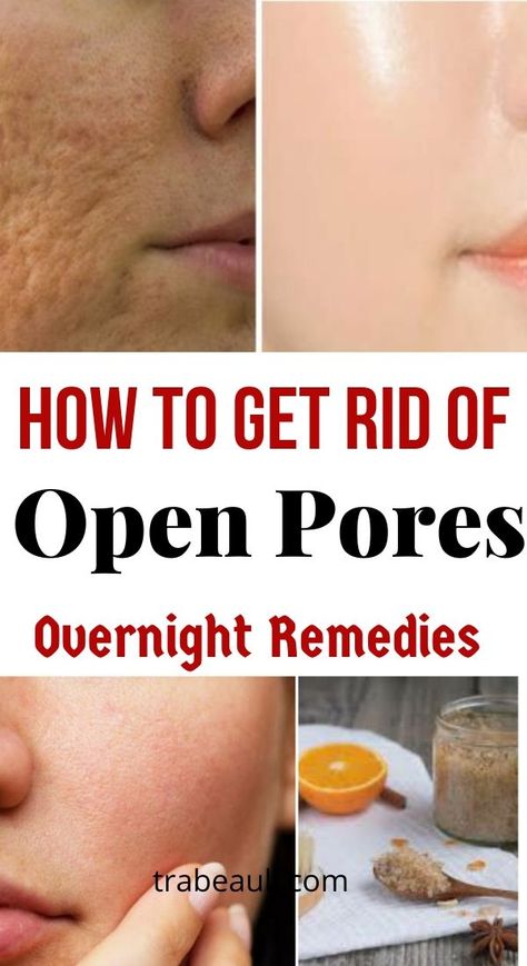 Open Pores On Face, Overnight Remedies, Get Rid Of Pores, Acne Prone Skin Care, Lotion For Oily Skin, Face Pores, Tips For Oily Skin, Anti Wrinkle Skin Care, Open Pores