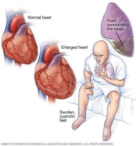 Heart failure - Symptoms and causes - Mayo Clinic Heart Symptoms, Enlarged Heart, Heart Valves, Normal Heart, Heart Defect, Heart Care, Congenital Heart, Heart Muscle, Dream Symbols