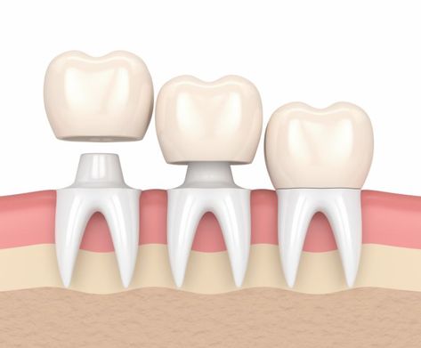 Lush Toothy Tabs Dentist Review Dental Crown Procedure, Affordable Dental Implants, Tooth Crown, Dental Tips, Dental Restoration, Dental Aesthetics, Dental Implant Surgery, Dental Fun, Dental Facts