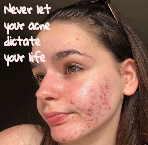 Face Dermal Piercing, Face Dermal, Best Dark Spot Corrector, Bad Acne, Dermal Piercing, Improve Energy, Lighten Dark Spots, Keto Lifestyle, Bare Beauty