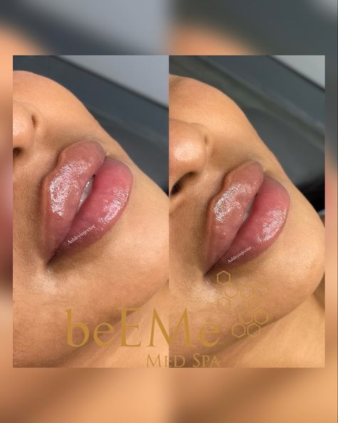 Lip filler using special technique Lip Injections Aesthetic, Lip Filler Black Women, Injections Aesthetic, Perfect Lips Injections, Lips Injection, Lip Fuller, Russian Lips Filler, Desired Lips, Filler Inspiration