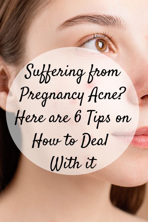 Suffering from Pregnancy Acne? Here are 6 Tips on How to Deal With It Breaking Out On Chin, Pregnancy Acne, How To Clear Pimples, Acne Diet, Pregnancy Bump, Pregnancy Hormones, Severe Acne, Skin Dryness, Acne Solutions