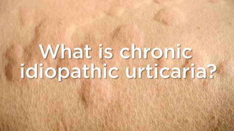 Chronic Hives, The Hives, Mast Cell Activation Syndrome, Stay Awake, Ice Packs, Trust Your Instincts, Medical Terms, Autoimmune Disorder, Loose Skin