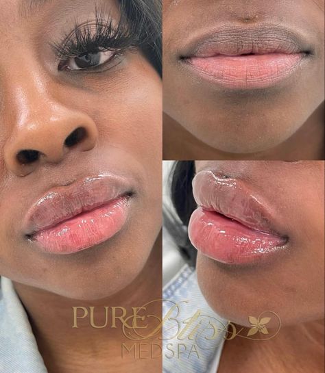 Lip Filler Before And After Black Women, Lip Filler Black Women, Lip Filler No Cupids Bow, Lip Filler Cupids Bow, Cupid Bow Lips Filler, Lip Filler Before And After, Lip Gloss Quotes, Lip Filler Inspo 0.5ml, 1.5 Ml Lip Filler