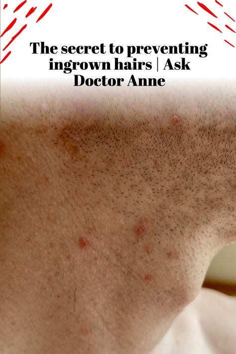 Are you fed up with ingrown hairs and want to learn how to prevent and treat them? Then look no further than this video! Here you will get all the up-to-date advice on how to prevent and treat ingrown hairs. Doctor Anne will provide her top tips on ingrown hair prevention, as well as give her professional opinion and insight on the best treatments available. No more searching endlessly for a solution - Doctor Anne will provide the answers. Treat Ingrown Hair, Inflamed Skin, Natural Face Cleanser, Homemade Facial Mask, Lower Back Pain Exercises, Natural Hair Mask, Best Barber, Prevent Ingrown Hairs, Ingrown Hairs