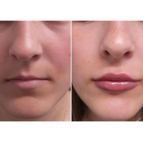 Upper Lip Wrinkles, Lips Inspiration, Botox Lips, Laser Clinic, Facial Fillers, Lip Augmentation, Laser Clinics, Small Lips, Lip Wrinkles