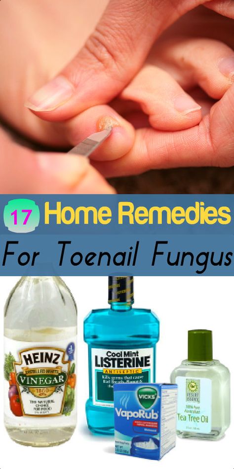 17 Home Remedies for Toenail Fungus Toenail Fungus Remedies, Tongue Health, Toenail Fungus, Nail Fungus, Natural Health Remedies, Natural Home Remedies, Health And Beauty Tips, Natural Medicine, Tea Tree Oil