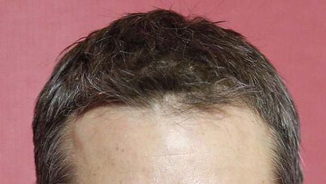 Different hairlines reveal different characters of the people. In face reading, Hairline shapes include high and broad, low and narrow, straight, round, M-shaped, Widow’s Peak and uneven ones. Face Reading, Meant To Be, Reading