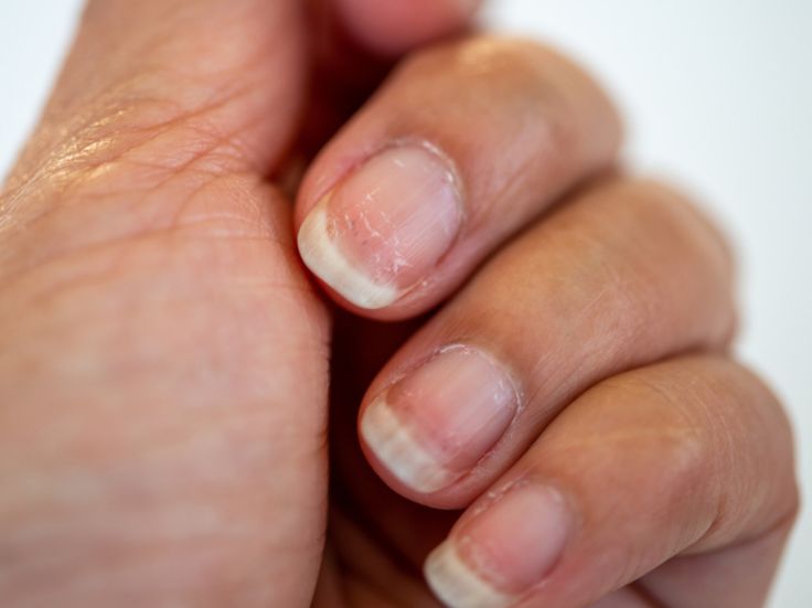 Hang up those hangnails for good. Pitted Nails, Quick Nail, Popular Nail Designs, Brittle Nails, Toenail Fungus, Nail Strengthener, Nail Fungus, Nail Health, Healthy Nails