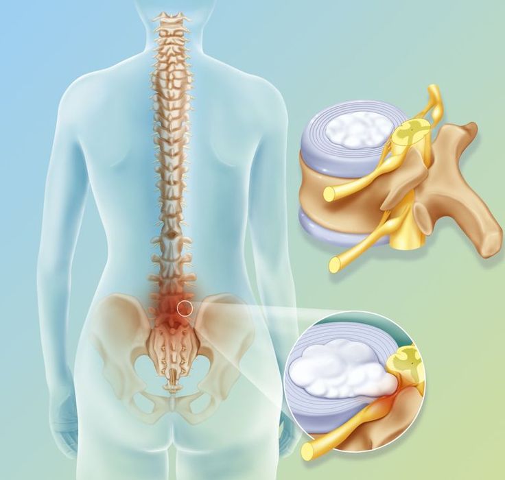 Illustration of a spinal disc herniation between L4/L5 (4th and 5th lumbar vertebrae) and L5/S1 (5th lumbar and 1st sacrum) Sciatica Symptoms, Lumbar Disc, Bulging Disc, Disk Herniation, Sciatica Pain Relief, Spine Surgery, Nerve Pain Relief, Sciatic Nerve Pain, Sciatica Pain