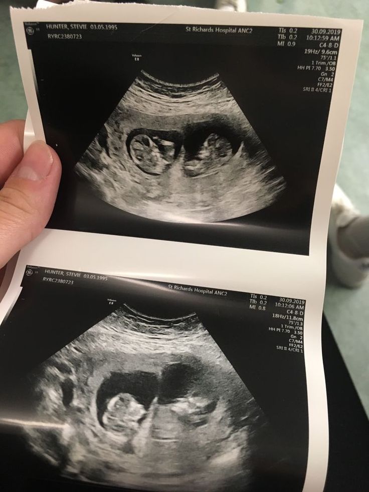 a person holding up an x - ray image in their hand