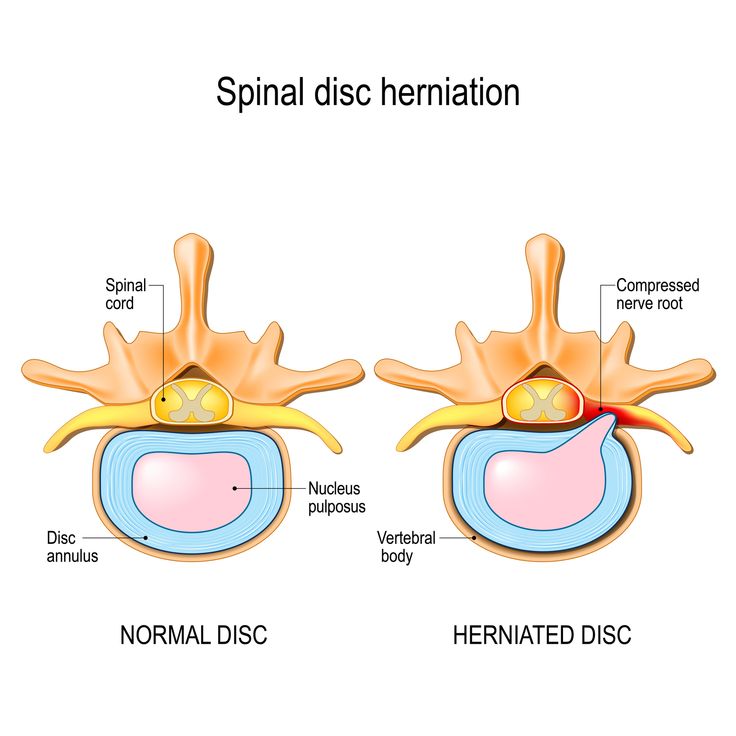 the normal and herniated discs are shown in this diagram, as well as their