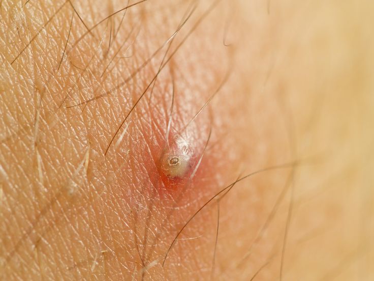 How to Get Rid of Ingrown Hair Ingrown Hair Under Armpit, Pulling Out Ingrown Hair, Infected Hair Follicle, Infected Ingrown Hair, Treat Ingrown Hair, Ingrown Hair Remedies, Ingrown Hair Removal, Armpit Fat, Prevent Ingrown Hairs