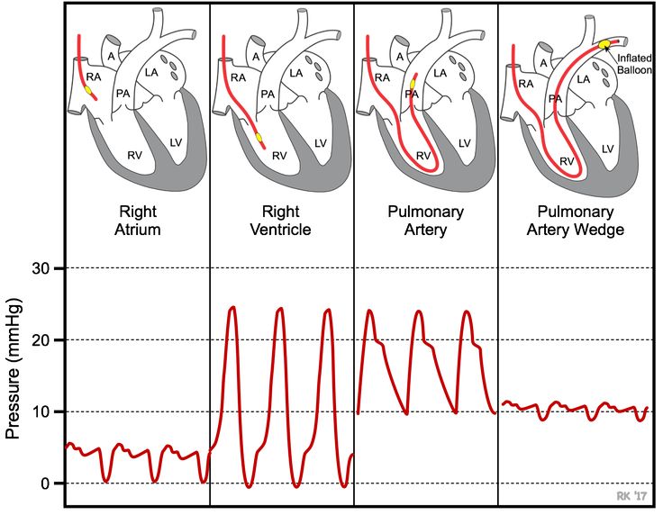 Pulmonary capillary wedge pressure Cath Lab Nursing, Cardiac Cath, Cath Lab Nurse, Heart Catheterization, Heart Pressure, Cardiac Anatomy, Cardiology Nursing, Nurse Anesthesia, Interventional Cardiology