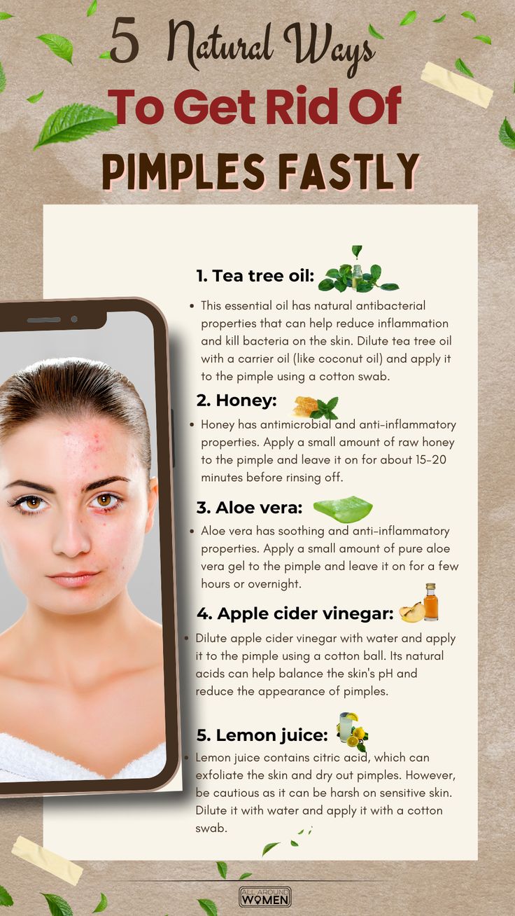 5 Natural Ways To Get Rid Of Pimples Fastly😍 #beauty #beautyhacks #pimple #acne, #pimples #overnightpimples #removepimples #removepimplesovernight https://whispers-in-the-wind.com/combatting-pimples-under-the-skin-expert-tips-and-product-recommendations/?98 Lip Pimple, Pimples On Scalp, Get Rid Of Pimples, Rid Of Pimples, Stubborn Acne, Back Acne, Pimples Under The Skin, Pure Aloe Vera Gel, Pimples Remedies