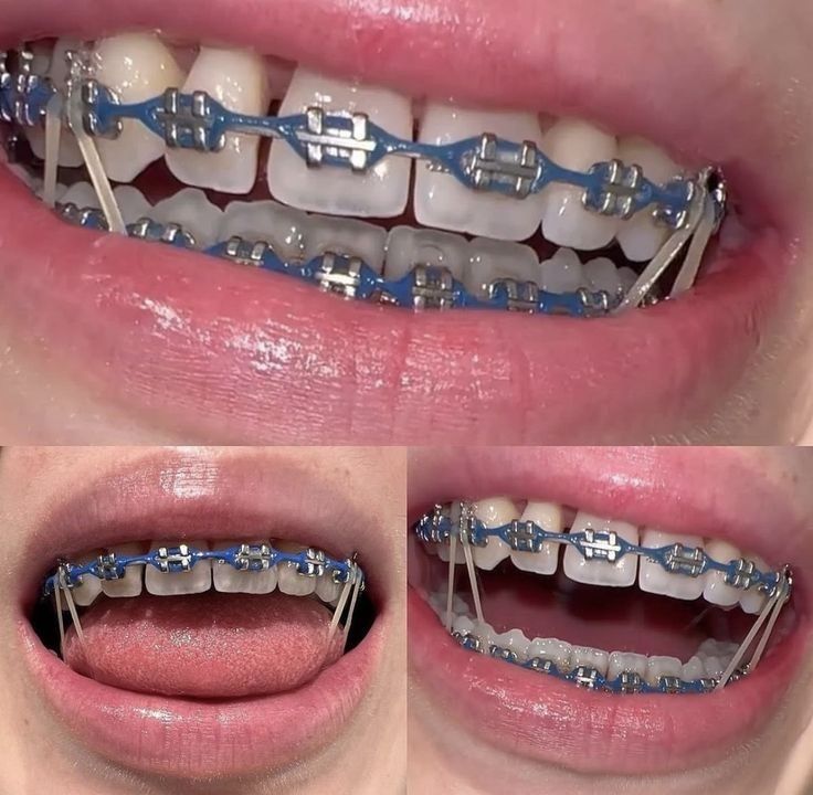 Midnight Glow Braces, Braces Chain Colors, Color Of Braces Ideas, Silver Power Chain Braces, Teeth Braces Colors, Power Chain Braces Colors Ideas, Power Chain Braces Colors, Brace Colors Ideas, Braces Aesthetic Colors