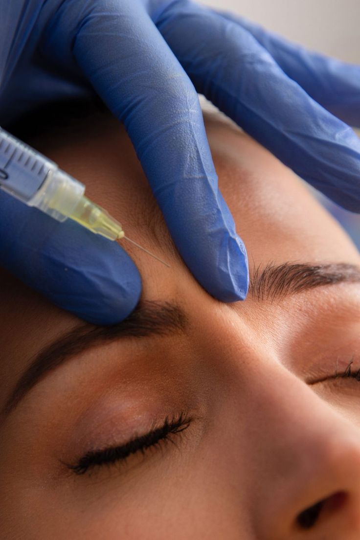 Trusted by countless expert injectors, Botox Cosmetic isn’t just a wrinkle relaxer; it’s a testament to precision and quality. Crafted in a state-of-the-art facility under stringent safety measures, each of […] Botox Photography, Botox Advertising, Botox Aesthetic Photography, Botox Stock Photo, Botox Astetic, Botox Nurse, Botox Aesthetic, Botox Results, Allergan Botox