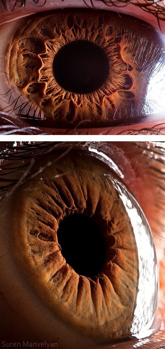 two pictures of the inside of an eye, one with brown eyes and one with black iris