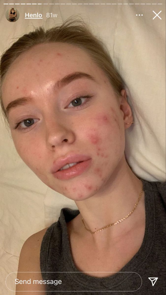 Acne Appreciation Aesthetic, Acne Face Aesthetic, People With Acne Pretty, Imperfect Skin Aesthetic, Acne Aesthetic Girl, Pimples Aesthetic, Makeup With Acne Showing, Girl With Acne Aesthetic, People With Pimples