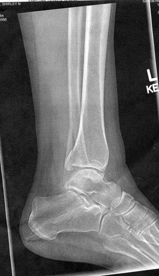 Broken Ankles 101 | HubPages Broken Ankle Cast, Broke Leg Snapchat, Fracture Photo, Ankle Cast, Broken Ankle Recovery, Ankle Fracture, Calf Cramps, Broken Foot, Ankle Surgery