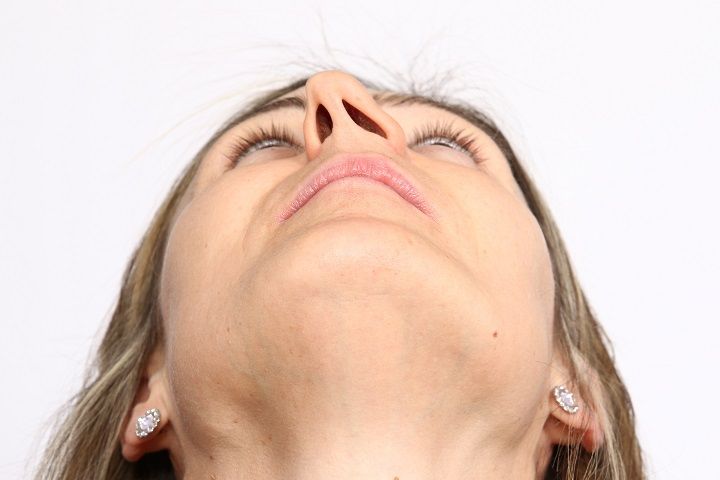 For treating your deviated septum you should ask an ENT doctor for help as this may cause severe nasal obstruction and lead to several health conditions. Deviated Nasal Septum Before And After, Deviated Nasal Septum Surgery, Deviated Nasal Septum, Nasal Obstruction, Sinus Allergies, Chronic Sinusitis, Nasal Septum, Ent Doctor, Sinus Headache