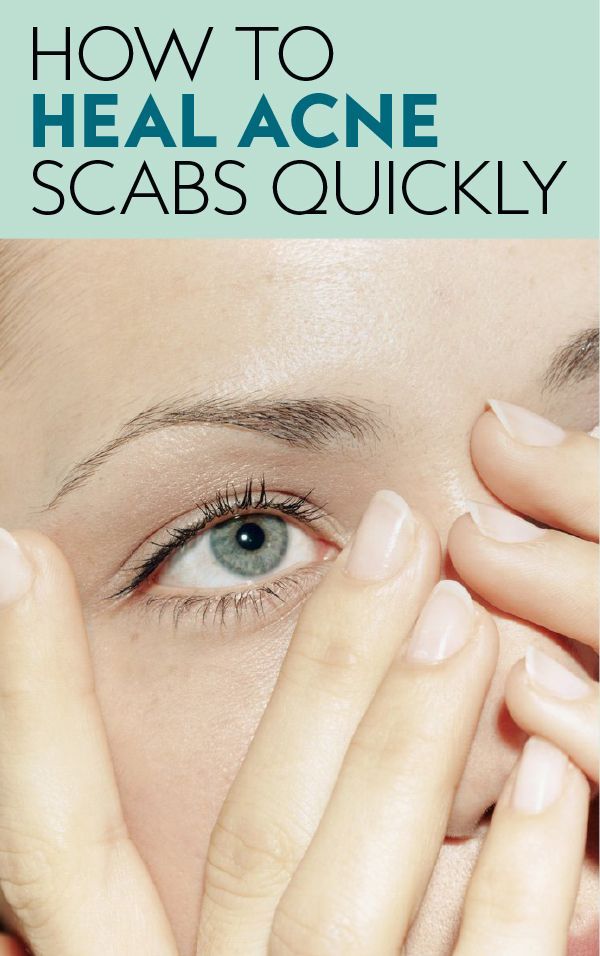 Here's the easiest and quickest way to heal your acne scabs. #howtocoverupacne #healacnescabs #coverupacnescabs #acnescars Scab On Face, Scab Healing, Acne Scab, Get Rid Of Acne, Rid Of Acne, Cat Eye Makeup, How To Get Rid Of Acne, Fall Makeup, Skin Tips