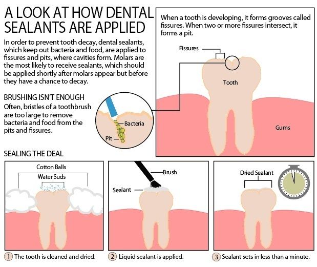 Dental Sealants Marietta Dental Sealants, Dental Appointment, Dental Insurance Plans, Pediatric Dental, Dental Kids, Dental Cleaning, Pediatric Dentistry, Dental Insurance, Dental Services