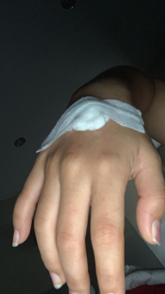 a person's hand with white patches on it