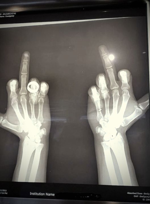 an x - ray image of two hands showing the bones