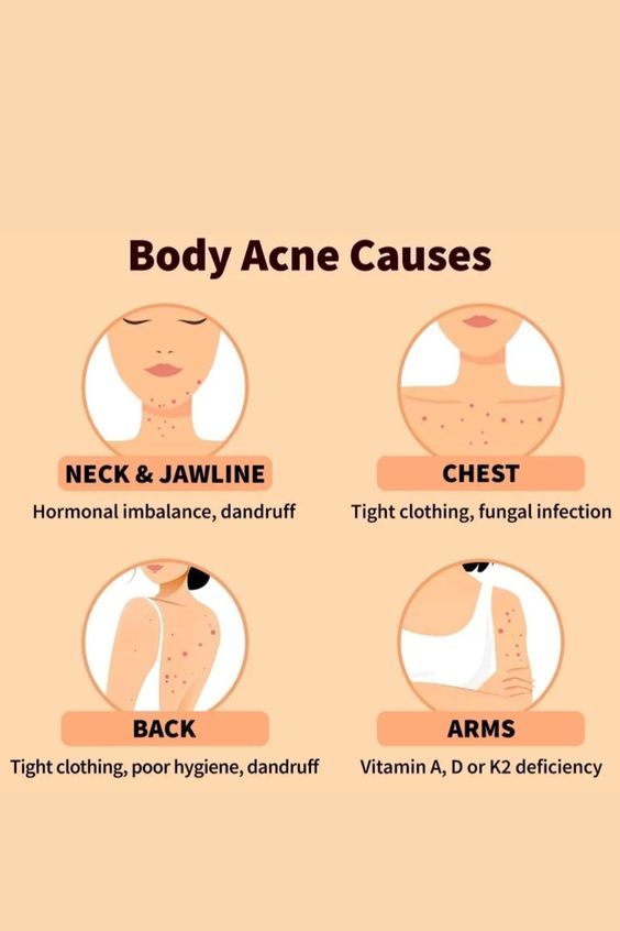 body acne causes, acne Bad Acne, Skin Advice, Acne Skincare, Natural Face Skin Care, Natural Acne Remedies, Types Of Acne, Acne Causes, Body Acne, Basic Skin Care Routine