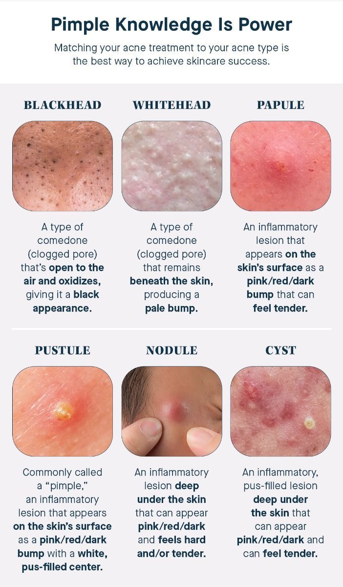 Types of Pimples Types Of Pimples, Different Types Of Acne, Blind Pimple, Pimples Under The Skin, Acne Overnight, Pimples On Face, Types Of Acne, How To Get Rid Of Pimples, Acne Spots