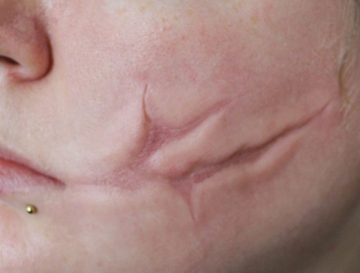 a woman's nose with acne on it and gold studs around the lip