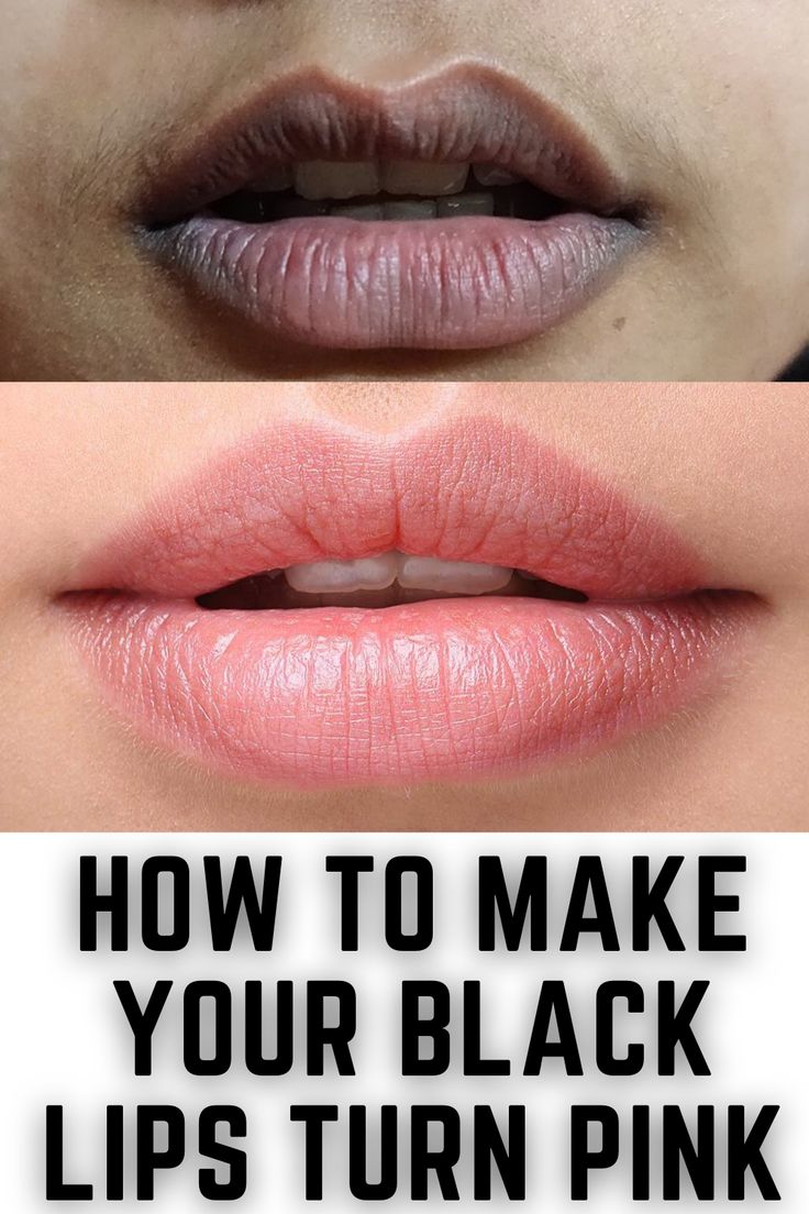 Remove Darkness Around Mouth, Darkness Around Mouth, Pigmentation Remedy, Remedies For Dark Lips, Lighten Dark Lips, Natural Pink Lips, Lip Lightening, Mouth Lips, Lips Black