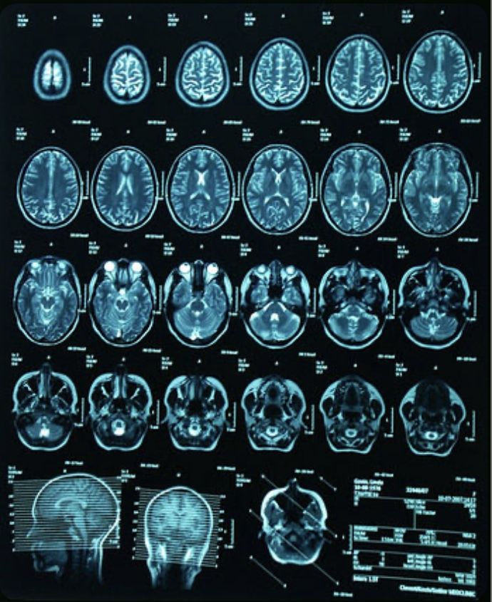 an x - ray image of the human brain