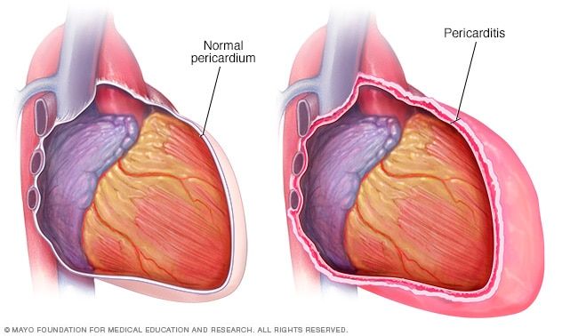 Nursing Study Notes, Pericardial Effusion, Human Heart Anatomy, Pharm Tech, Medical Things, Medical Ultrasound, Pleural Effusion, Health Heart, Heart Anatomy