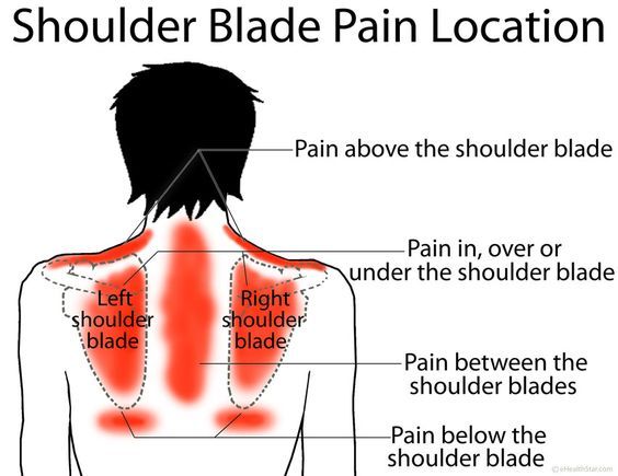 Pinched Nerve In Shoulder, Shoulder Blade Muscles, Shoulder Blade Pain, Fibermyalgia Symptoms, Muscle Knots, Pinched Nerve, Shoulder Pain Relief, Upper Back Pain, Shoulder Tattoos