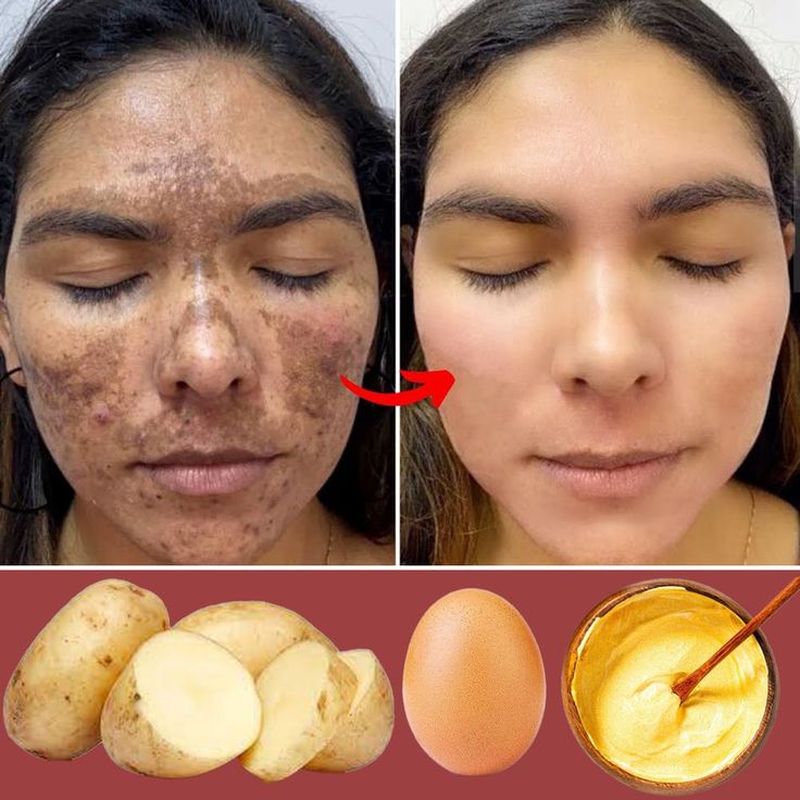 Potato Face Mask, Potato Face, Natural Skin Care Ingredients, Dark Spots On Face, Natural Skin Care Remedies, Skin Renewal, Diy Skin Care Routine, Natural Face Skin Care, Dry Skin Remedies