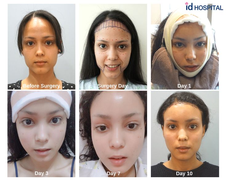 Forehead Reduction Surgery, Forehead Reduction, Hospital Surgery, Face Plastic Surgery, V Line Surgery, Forehead Lift, Korean Plastic Surgery, Plastic Surgery Photos, Face Surgery