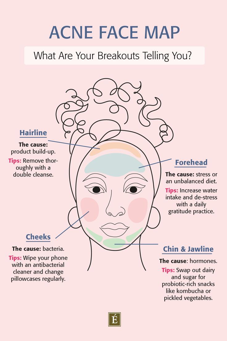 Pimple Chart, Face Acne Remedies, Acne Chart, Acne Face Map, Face Map, Face Mapping Acne, Blind Pimple, Forehead Acne, Pimples Under The Skin