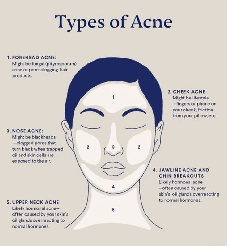 Meaning Of Pimples On Face, Acne Location Meaning Face Mapping, Acne Above Lip Meaning, Pimples And Their Meaning, Acne Chin And Jaw, Pimple Meaning Face Mapping, Facial Mapping Acne, Acne Causes On Face Chart, Acne Reasons Face Mapping